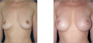 Breast Surgery 1 - Breast Aug 1 2 Breast Aug 1 - Breast Surgery 1