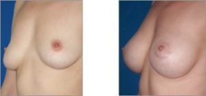 Breast Surgery 2 - Breast Aug 2 4 Breast Aug 2 - Breast Surgery 3