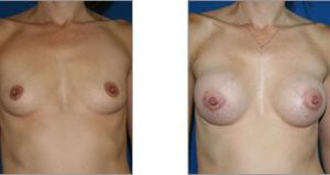 Breast Surgery 3 - Breast Aug 3 6 Breast Aug 3 - Breast Surgery 5