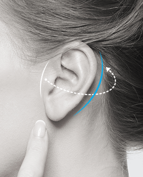 bat ear correction - bat ears
